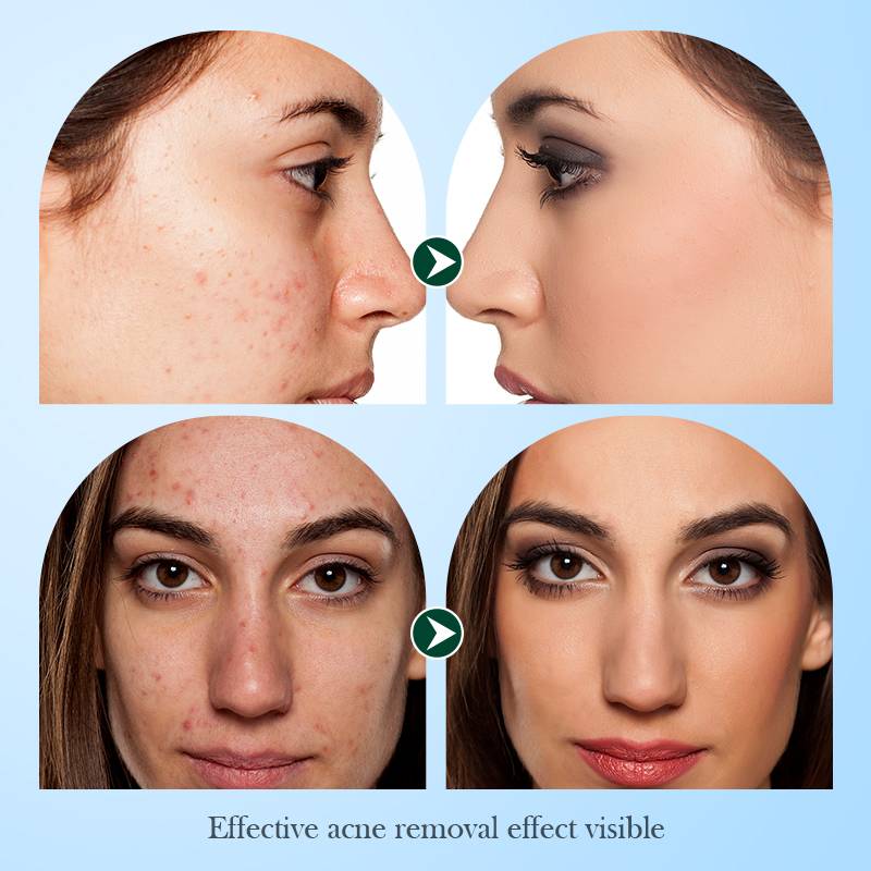Sadoer Tea Tree Acne Oil Control Anti-Acne Facial Sheet Mask