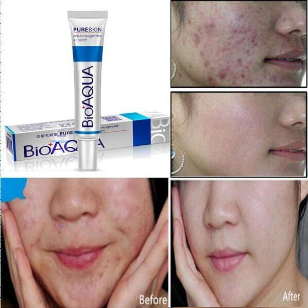 BIOAQUA 2 Pcs Anti Acne Scar Mark Remover Acne Scar Removal Cream